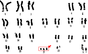 Wikipedia Commons 21_Down_syndrome
